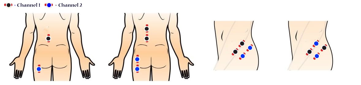 How Do I Place my TENs Machine’s Electrode Pads for chronic hip pain